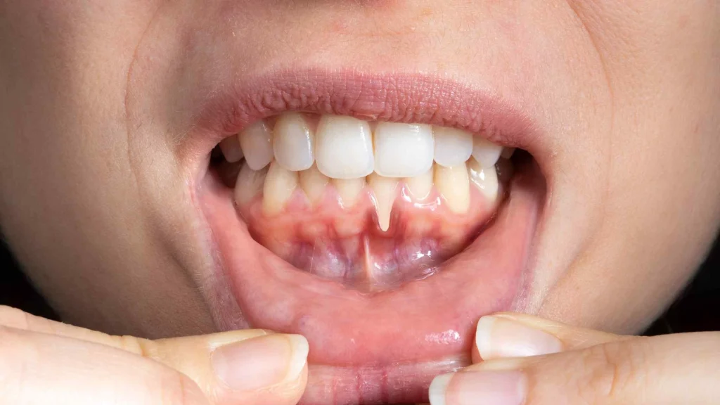 Gusi Berdarah Panduan Lengkap Cara Mencegah Gusi Berdarah Sejak Dini Untuk Kesehatan Mulut Optimal